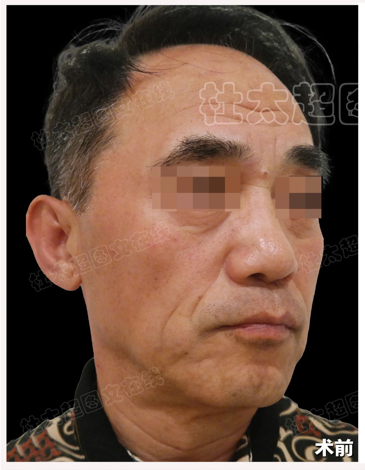 63岁大叔拉皮术后4年，他的脸为何能如此年轻？真相来了！