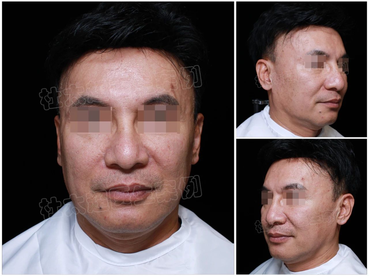 每次看到这类型的求美者就会很心疼很多求美者的颜值，可以说，成也鼻子败也鼻子❗️