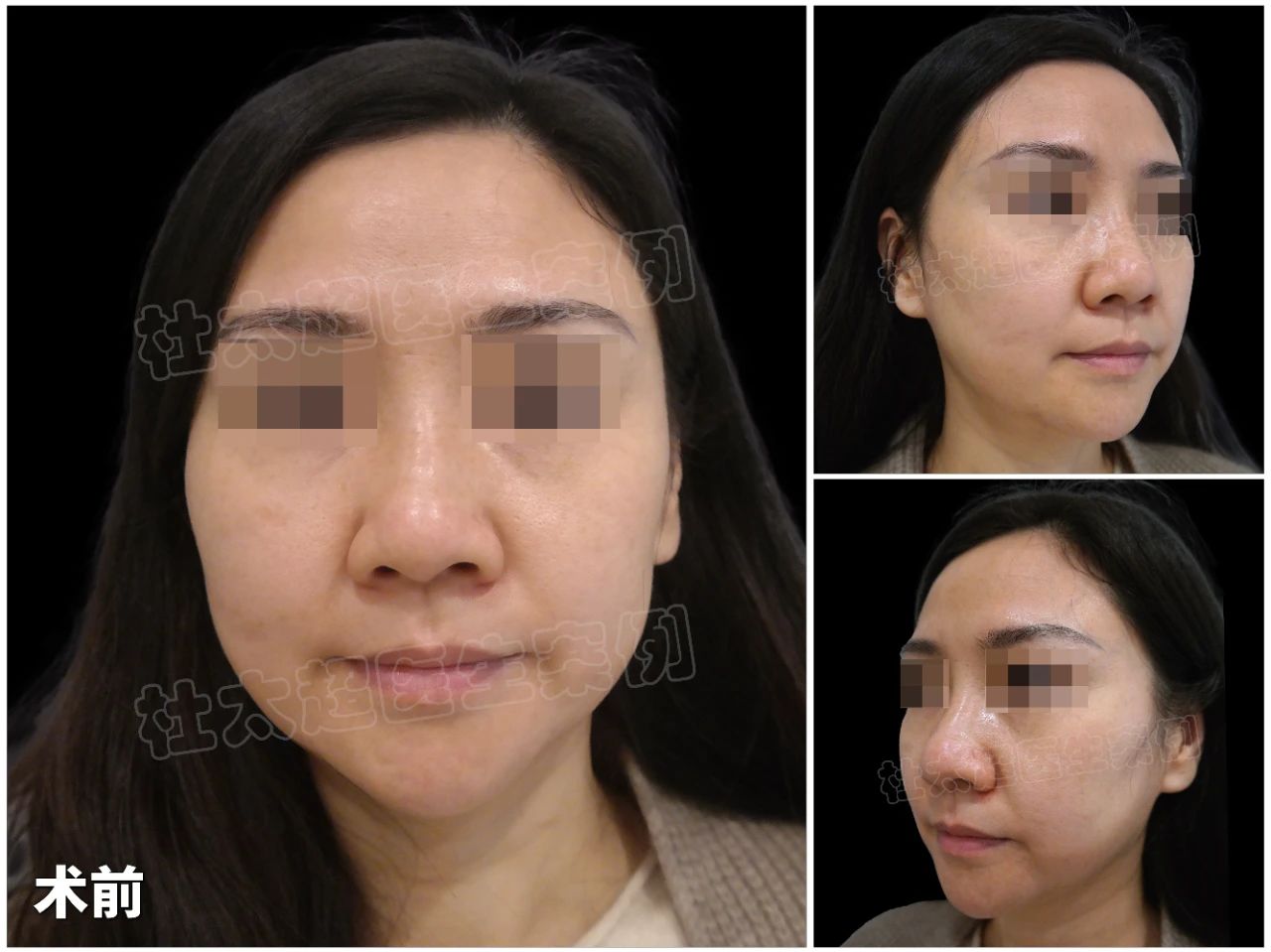 娱乐圈明星同款抗衰项目！48岁女士拉皮手术效果曝光，惊艳四座！？