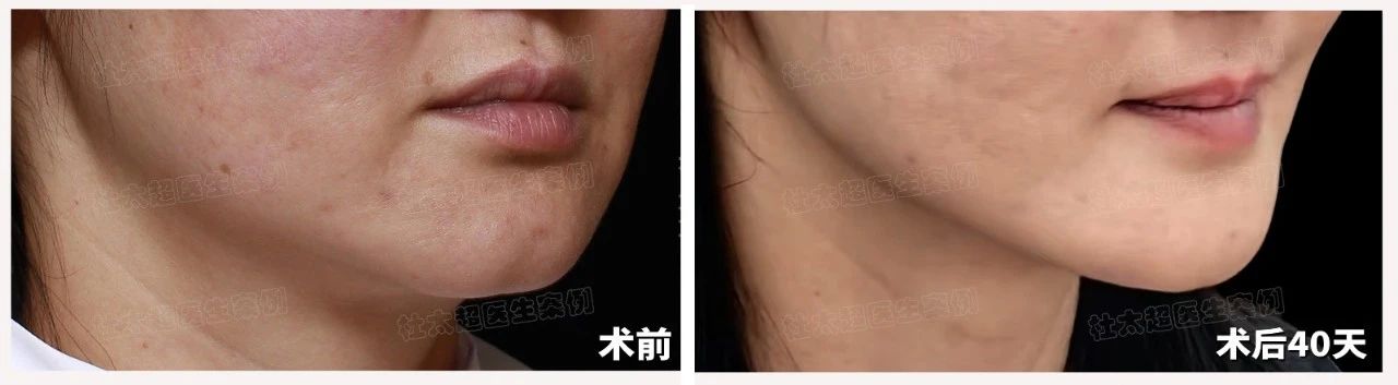 “偷感”整形的时代过去了，现在大家都......