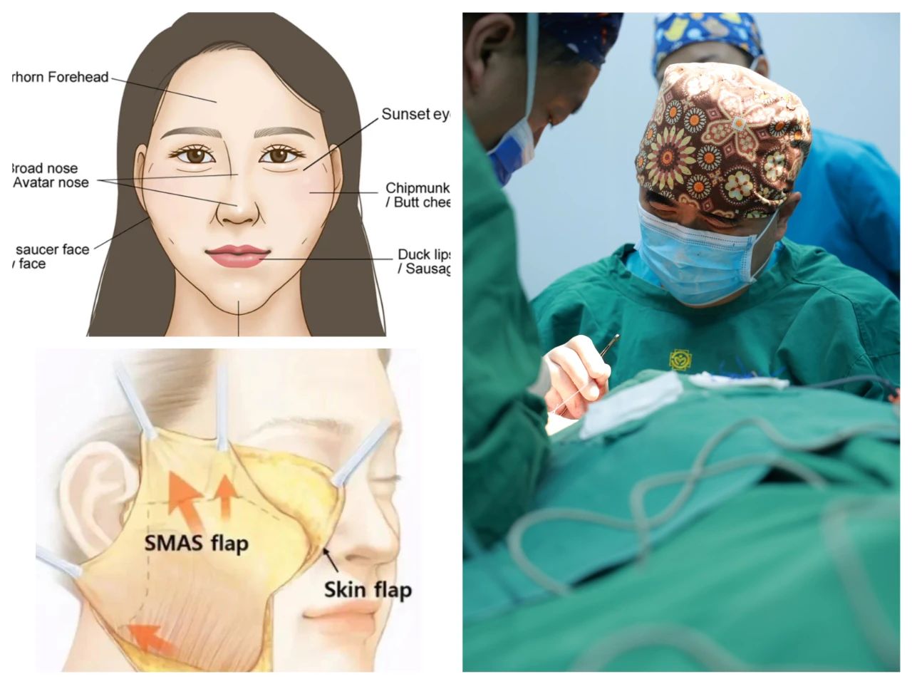 关于拉皮手术的4个惨痛教训：如何借助caw小切口面部提升缩紧术避免？