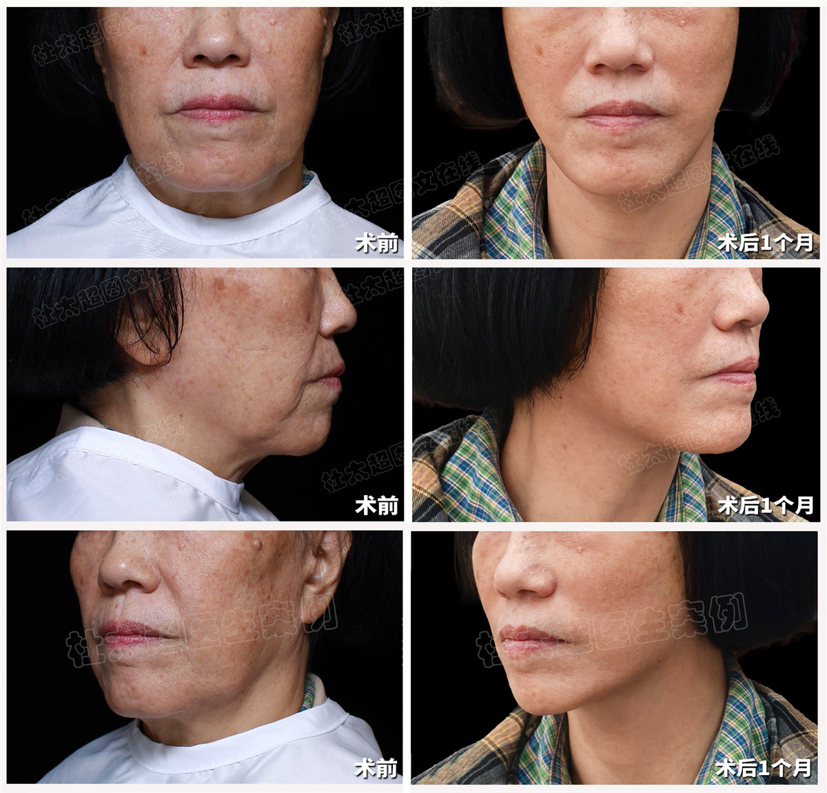 预算有限又想做拉皮手术，方案如何优化？