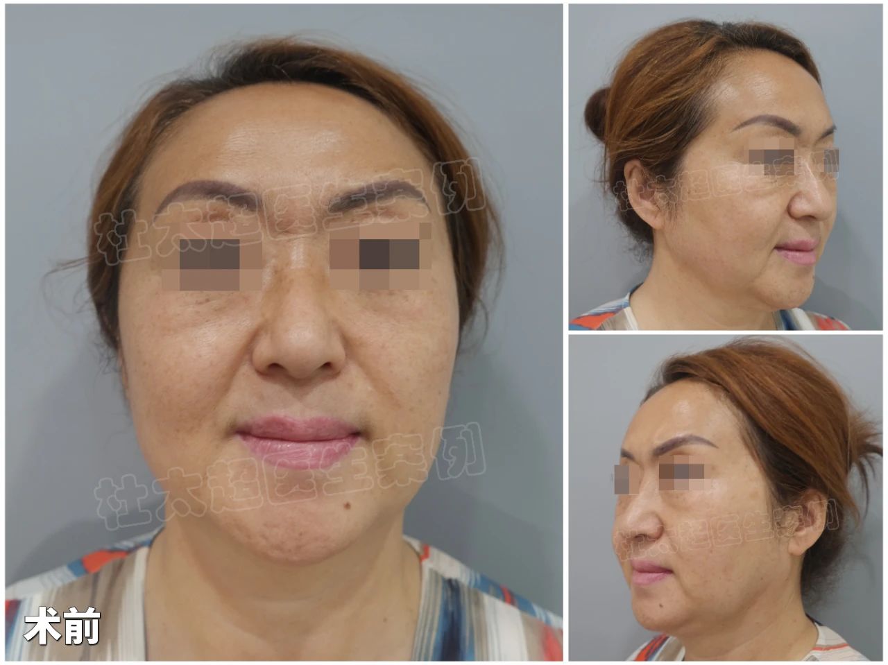 网红效应？！56岁求美者caw术后大变样，引爆朋友圈热议！