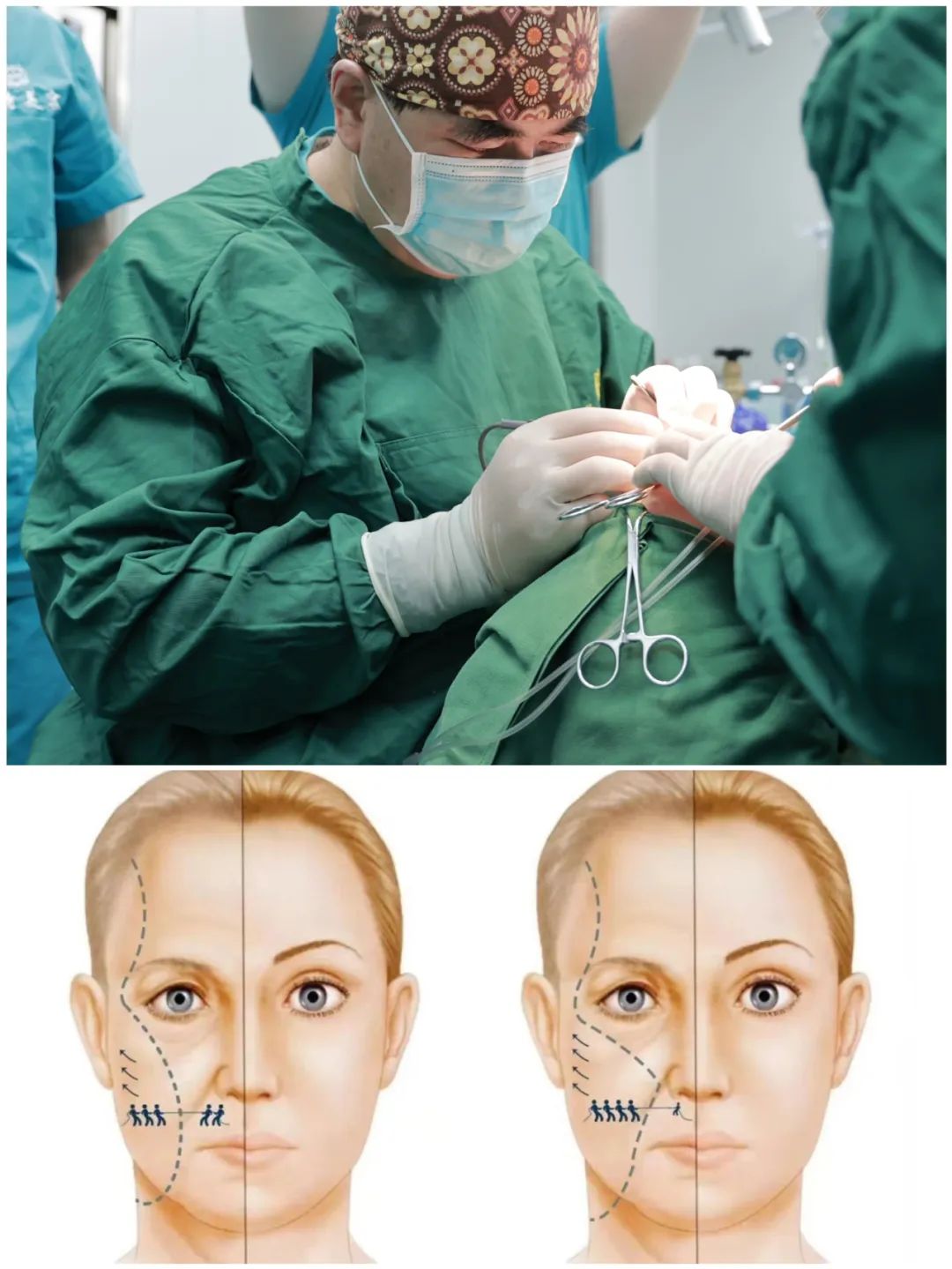 医美变“噩梦”？揭秘“馒化脸”现象背后的真相！caw小切口面部提升缩紧术能否重塑面部美丽？