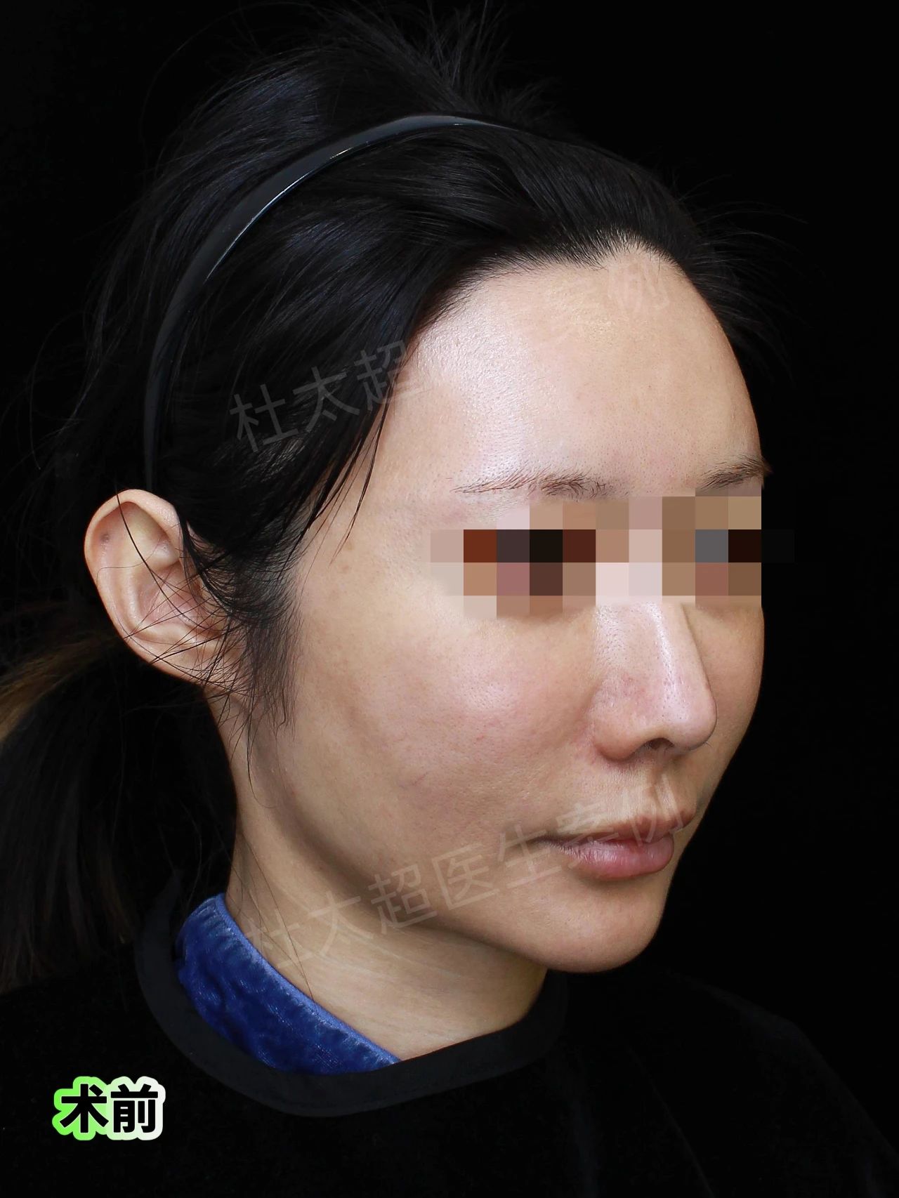 惊！下颌缘松弛秒变精致，拉皮提升让下颌缘紧致如初！