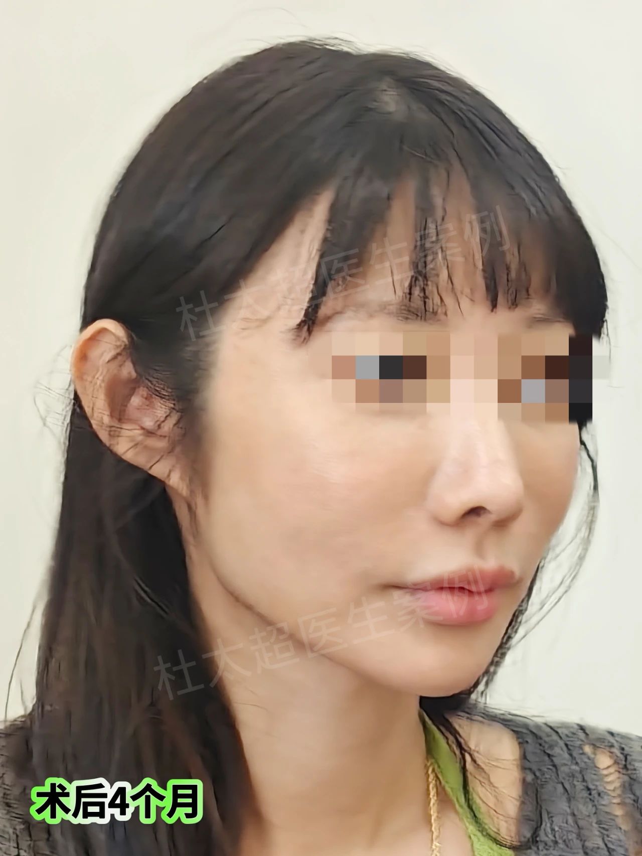 惊！下颌缘松弛秒变精致，拉皮提升让下颌缘紧致如初！