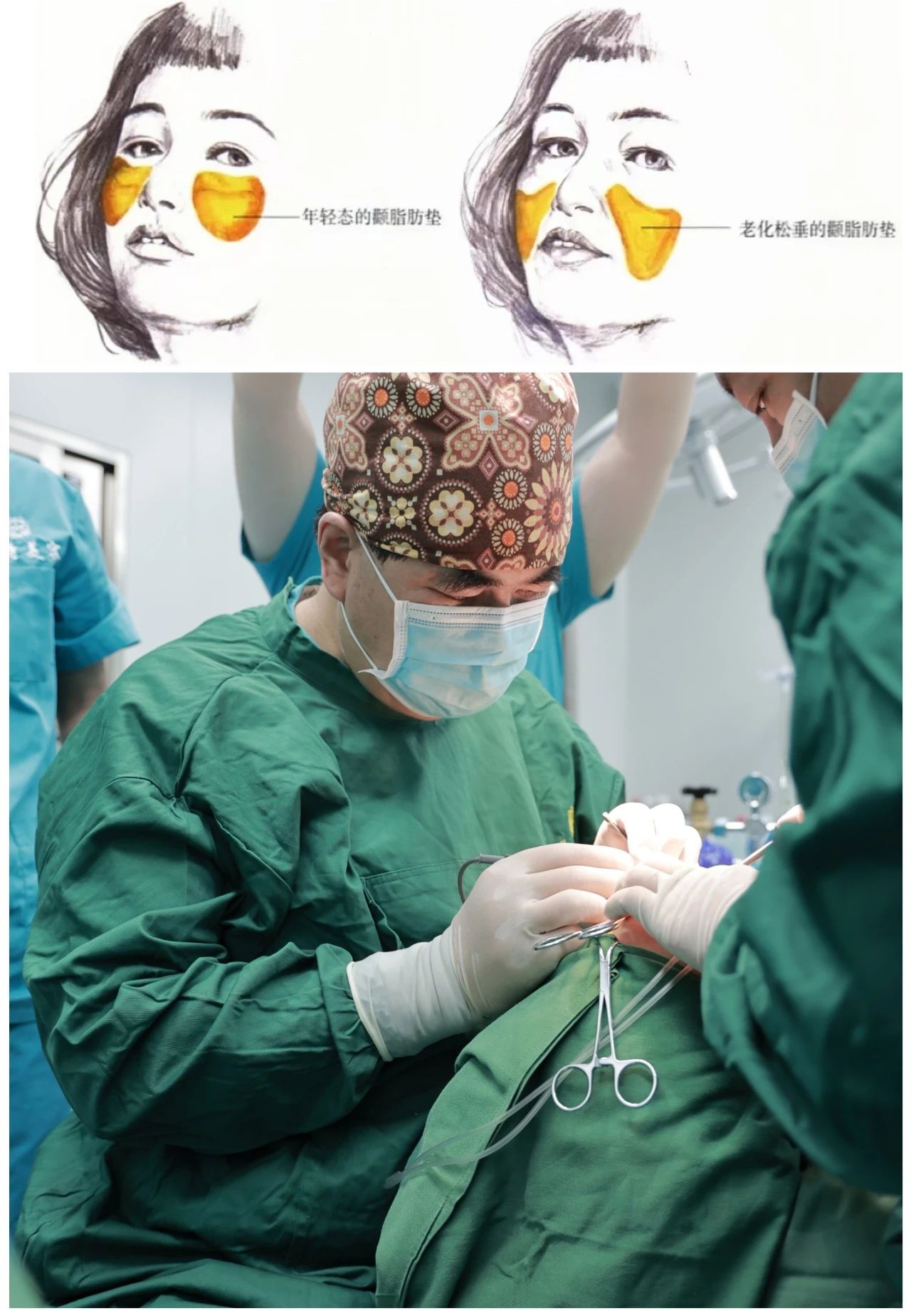 拉皮能变漂亮？美丽和年轻是两个概念——探秘caw小切口面部提升缩紧术