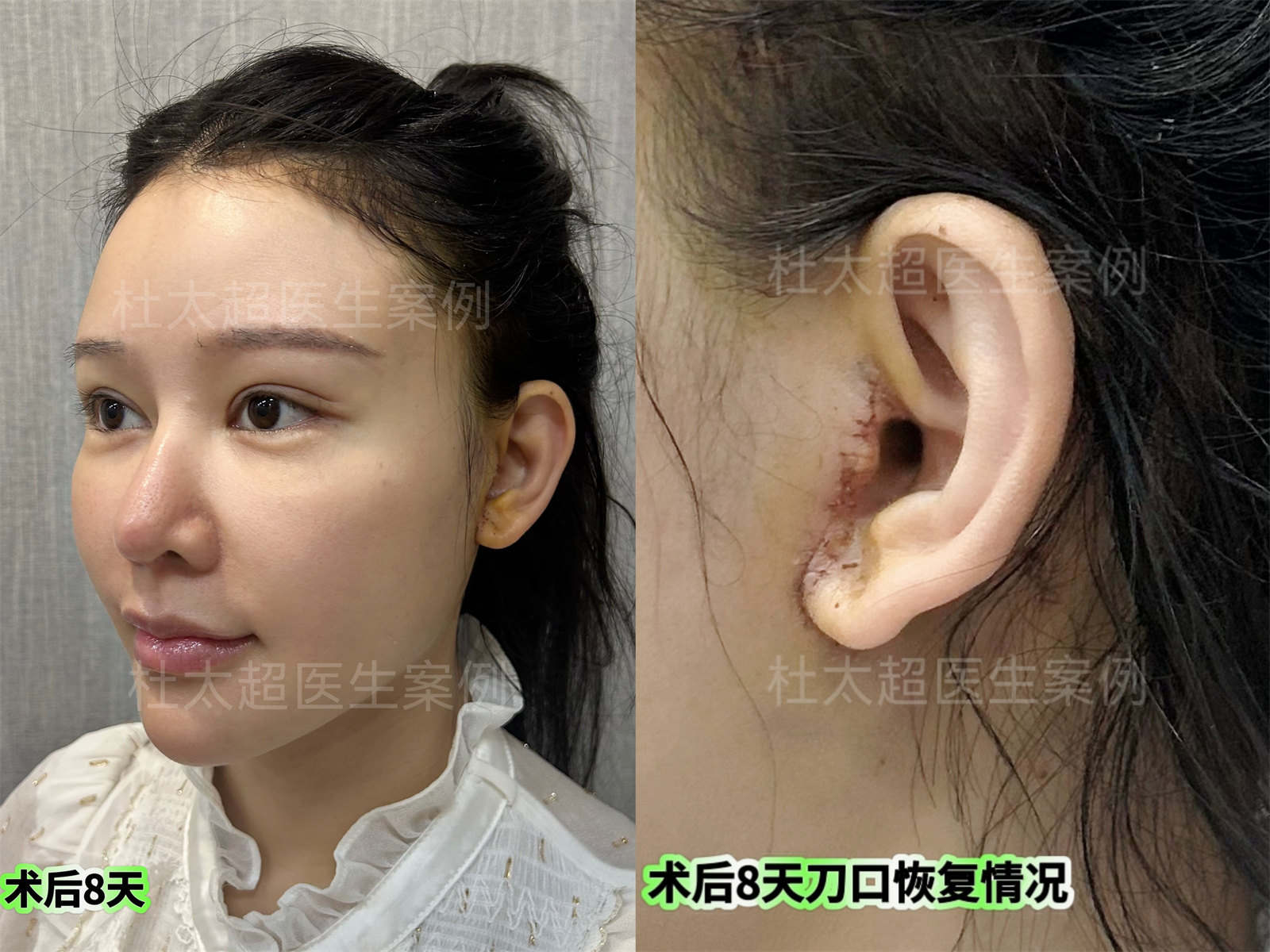 做完拉皮手术半年，聊聊我的感受