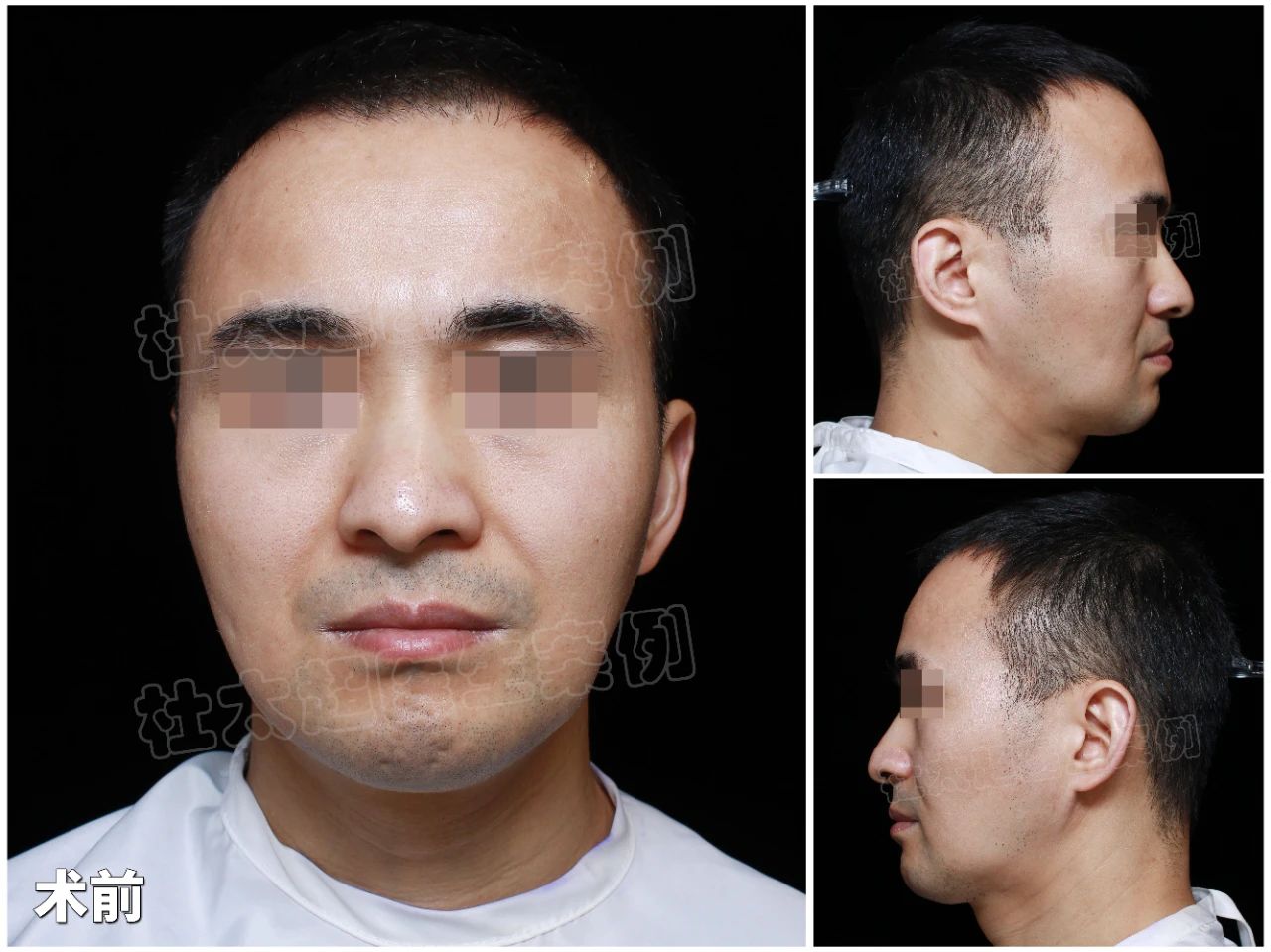 劲爆！男人为了拉皮手术，竟编出这些奇葩理由？真相惊人！