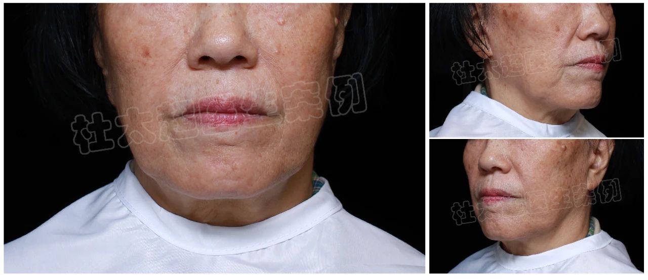 当葡萄籽提取物、美白丸、抗糖丸、NMN保健品都没有用时，我选择了拉皮手术！