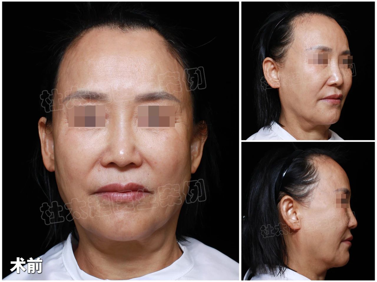 整形不是罪，57岁的我如何挑战岁月，重获25岁的容颜？