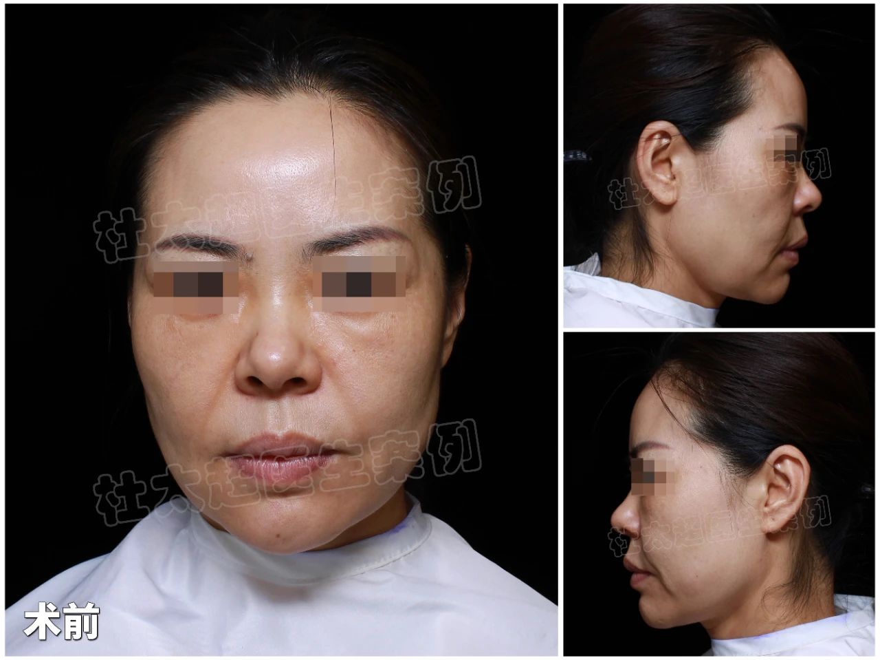 以手术刀为笔，绘就心灵与容颜的双重之美 —— 42岁求美者拉皮手术后深度感悟