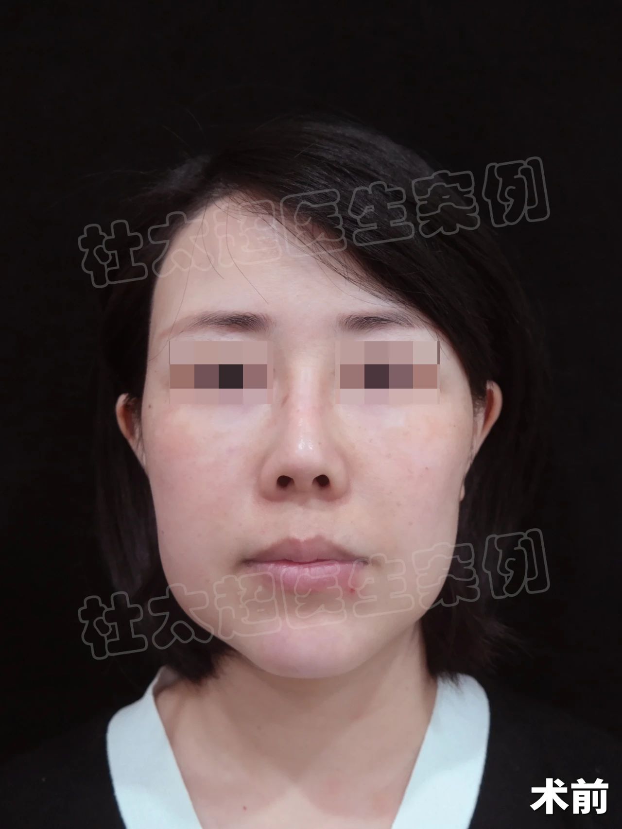 是的，我拉皮了！从“肿脸大妈”到“紧致女神”，震惊所有人！