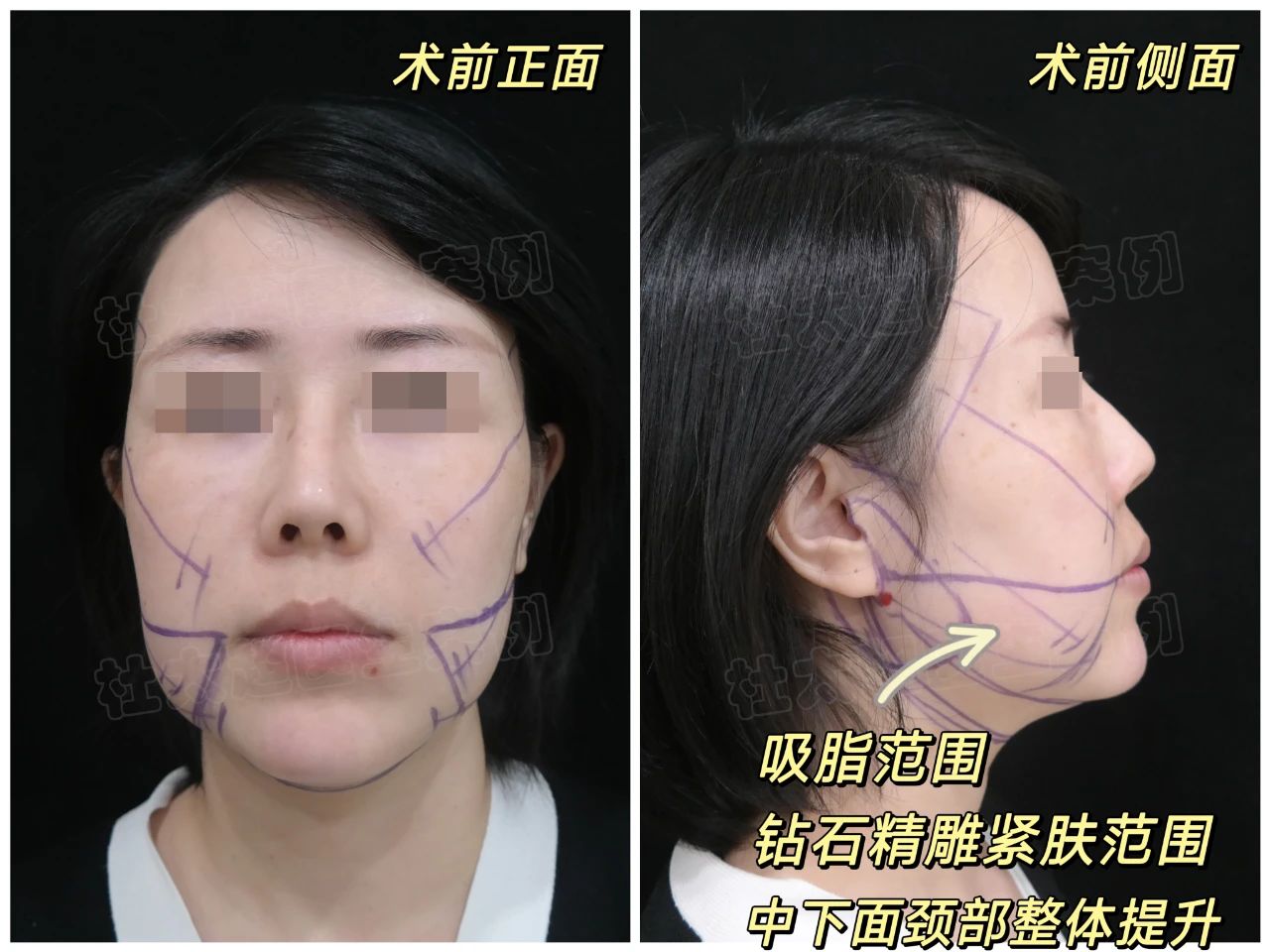 是的，我拉皮了！从“肿脸大妈”到“紧致女神”，震惊所有人！