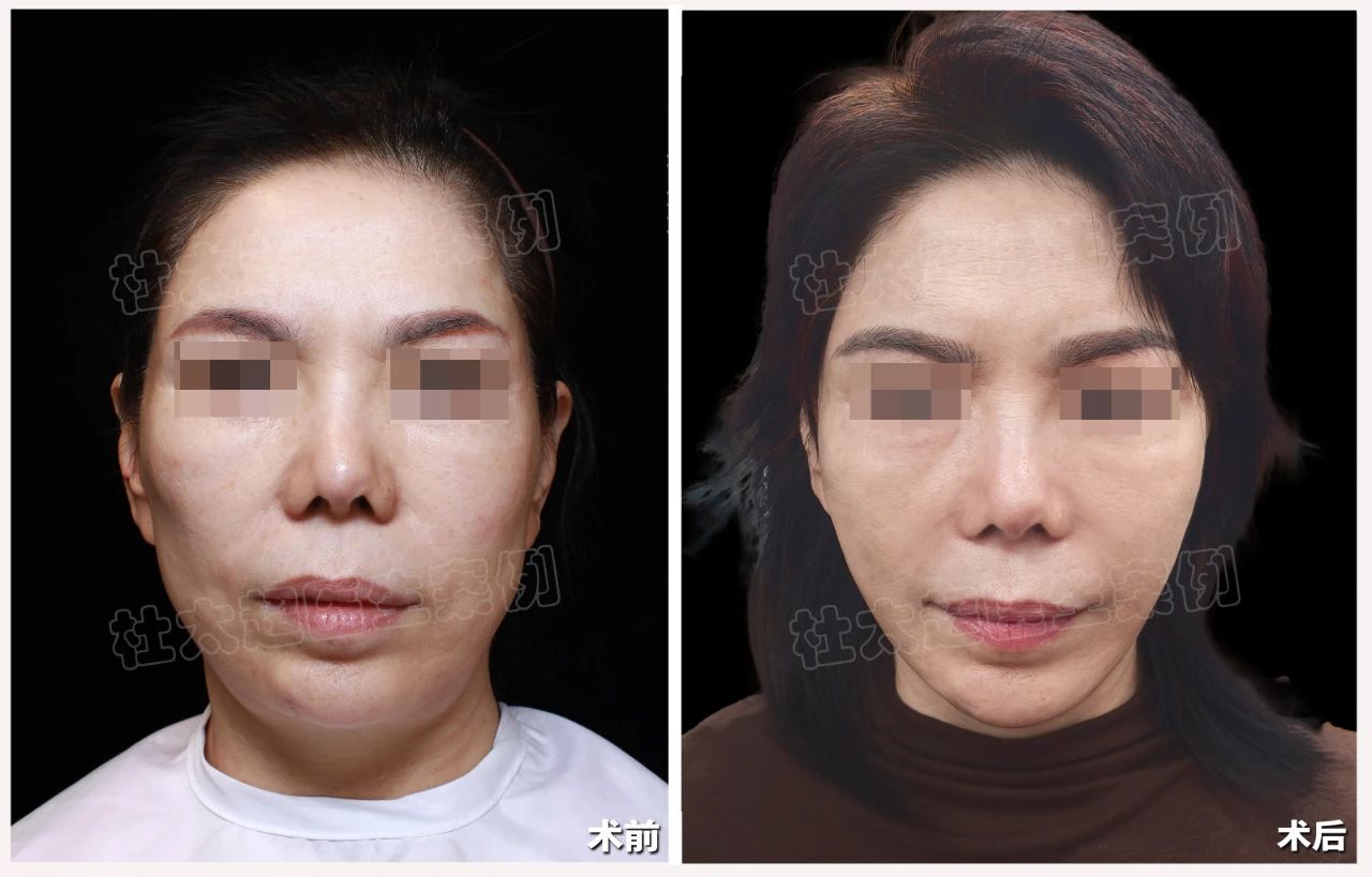 不装了！55岁大姐直言不讳：拉皮手术我做了！那又怎么样！人生苦短，我就要美丽绽放！