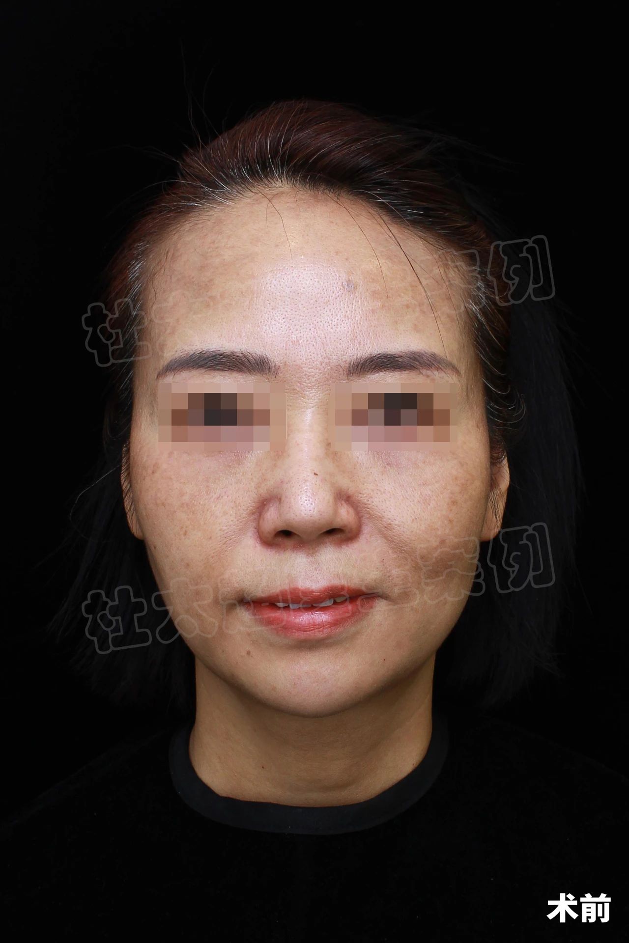 50岁阿姨拉皮手术后，7天不敢见人？出门后让人视觉受到严重冲击！