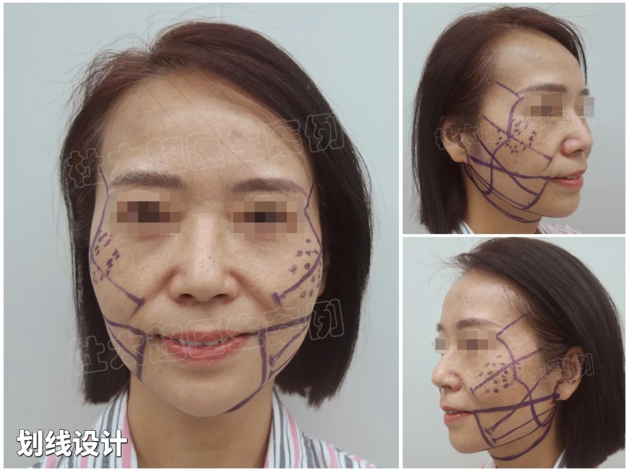 50岁阿姨拉皮手术后，7天不敢见人？出门后让人视觉受到严重冲击！