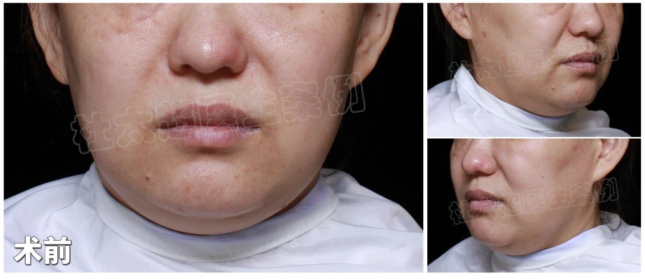 美丽背后的疑问：43岁的她如何在拉皮手术后实现心灵与外貌的蜕变？