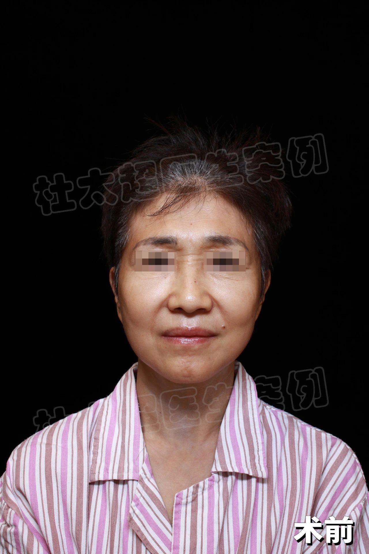 从“老树皮”到“小嫩叶”，60岁的我只做了个拉皮而已！