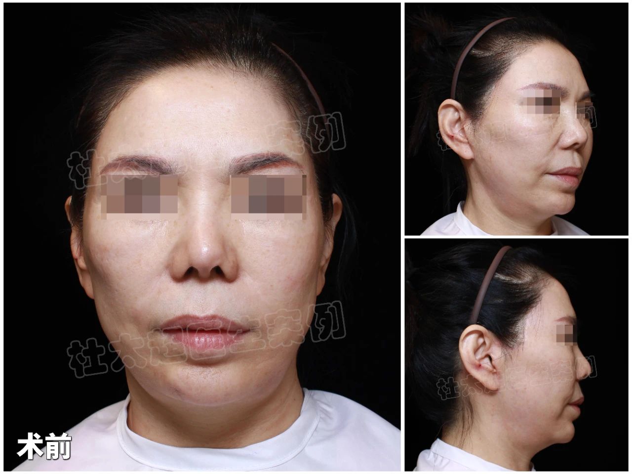 55岁职场“大姐大”的逆龄秘籍：拉皮手术并不可怕！