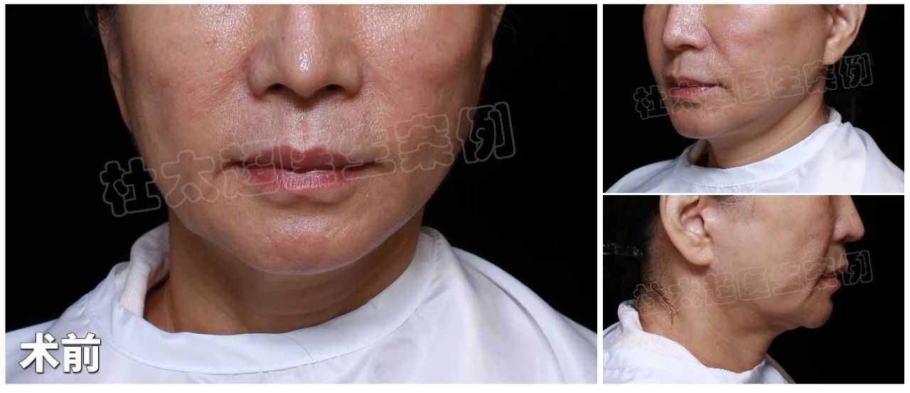 61岁海外归来，8天“换脸”成功，挑战拉皮手术年轻20岁成现实！