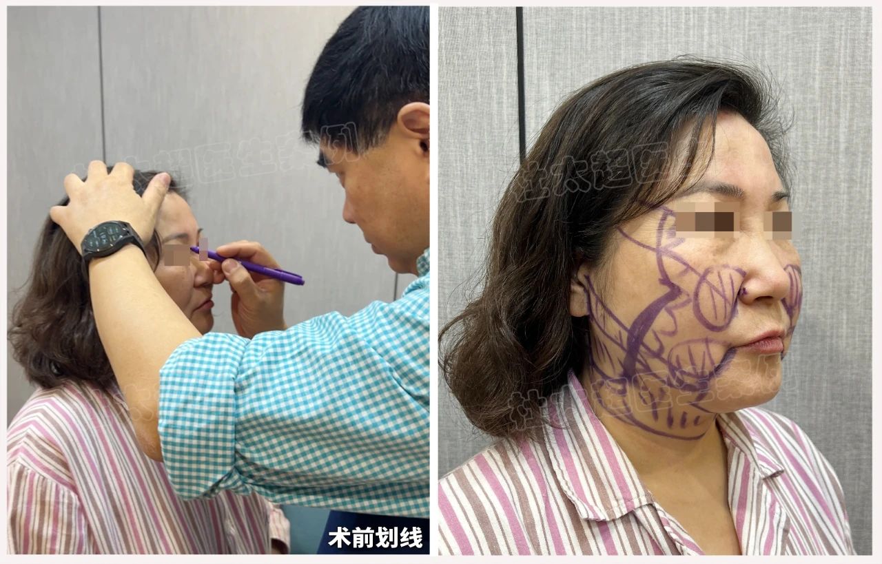 56岁阿姨3小时“换头”，拉皮手术8天后让人惊呼“救命”？