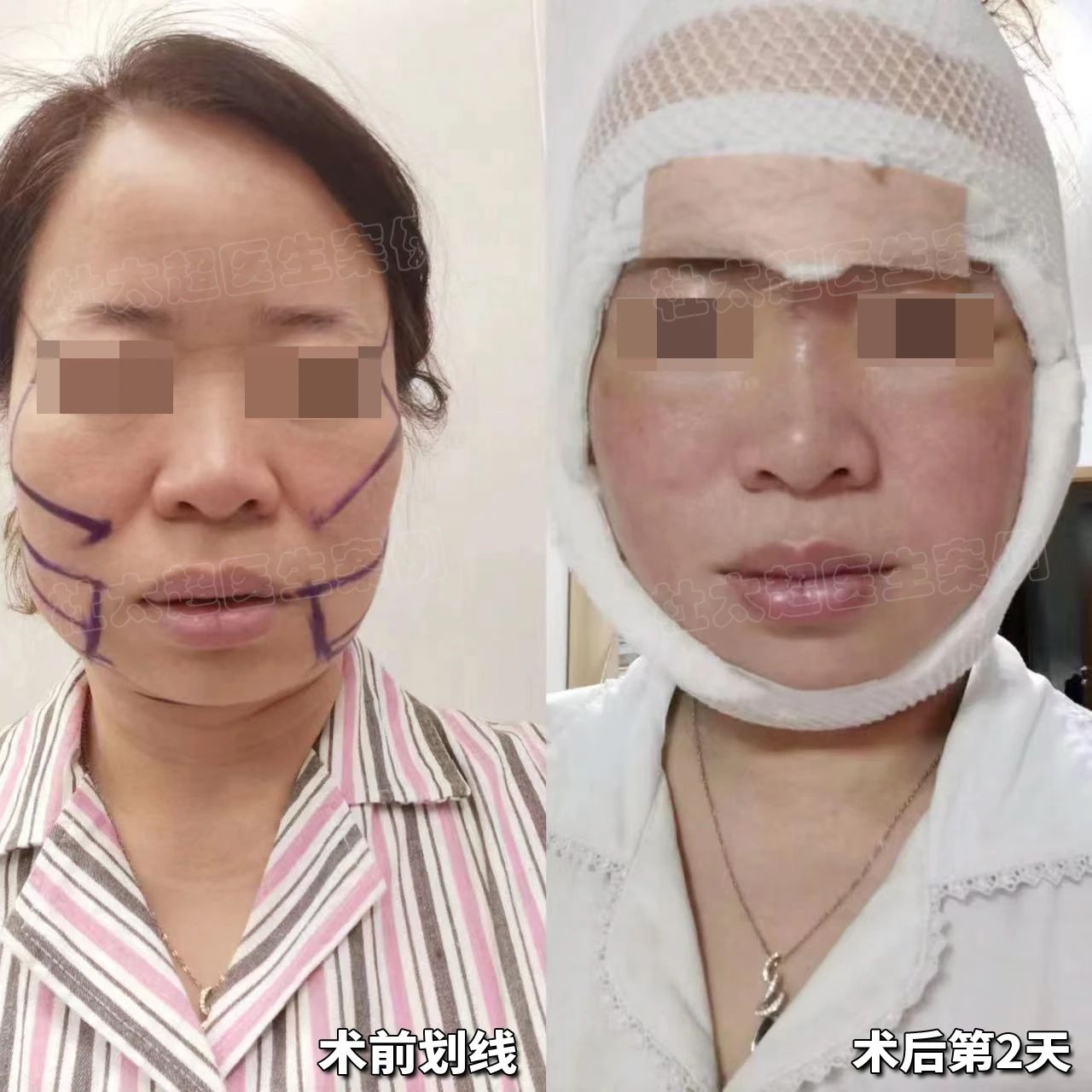 5岁整形烧钱？1天决策，3小时拉皮，7天变美，20岁青春再现，这波“逆袭”太精彩了，大女主梦想照进现实！