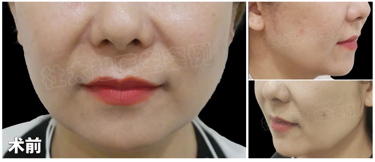 1句无心嘲讽，驱使她进行拉皮手术，48岁历经50天，实现惊人100%逆龄效果！