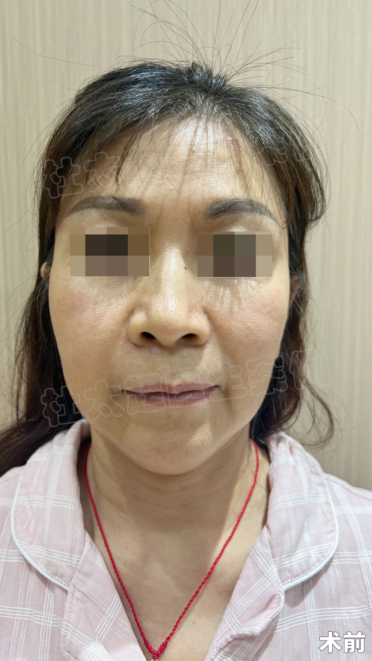 皱纹也怕川渝妹？1次拉皮手术能否让她重返18岁？18天、30天见证奇迹！