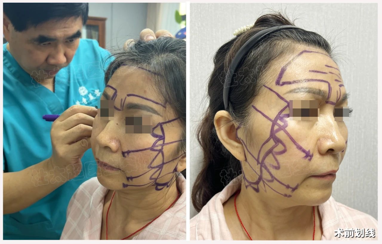 皱纹也怕川渝妹？1次拉皮手术能否让她重返18岁？18天、30天见证奇迹！