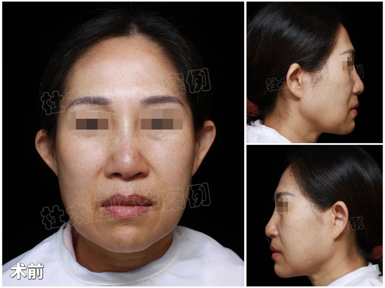 从60后到“90后”：3小时手术轻松搞定，7天恢复，15天美丽逆袭成功！