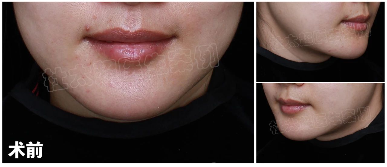 惊叹！33岁律师，拉皮手术后75天，实现薪资与颜值双翻倍？