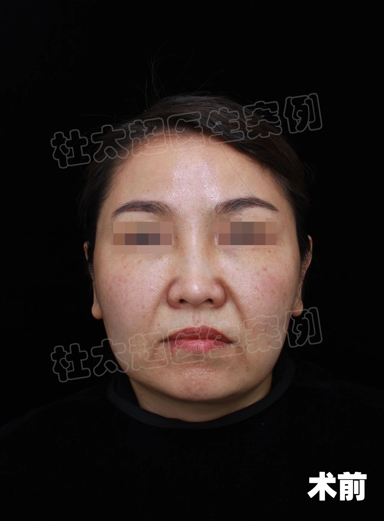 爆！43岁做了个“假拉皮”：以为要大动干戈，结果只是睡了个美容觉？