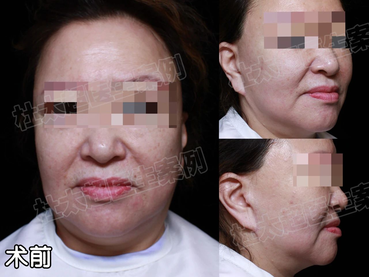 血泪史！3次拉皮手术是深渊还是救赎？不甘、害怕、焦虑，10天不懈的抗争！