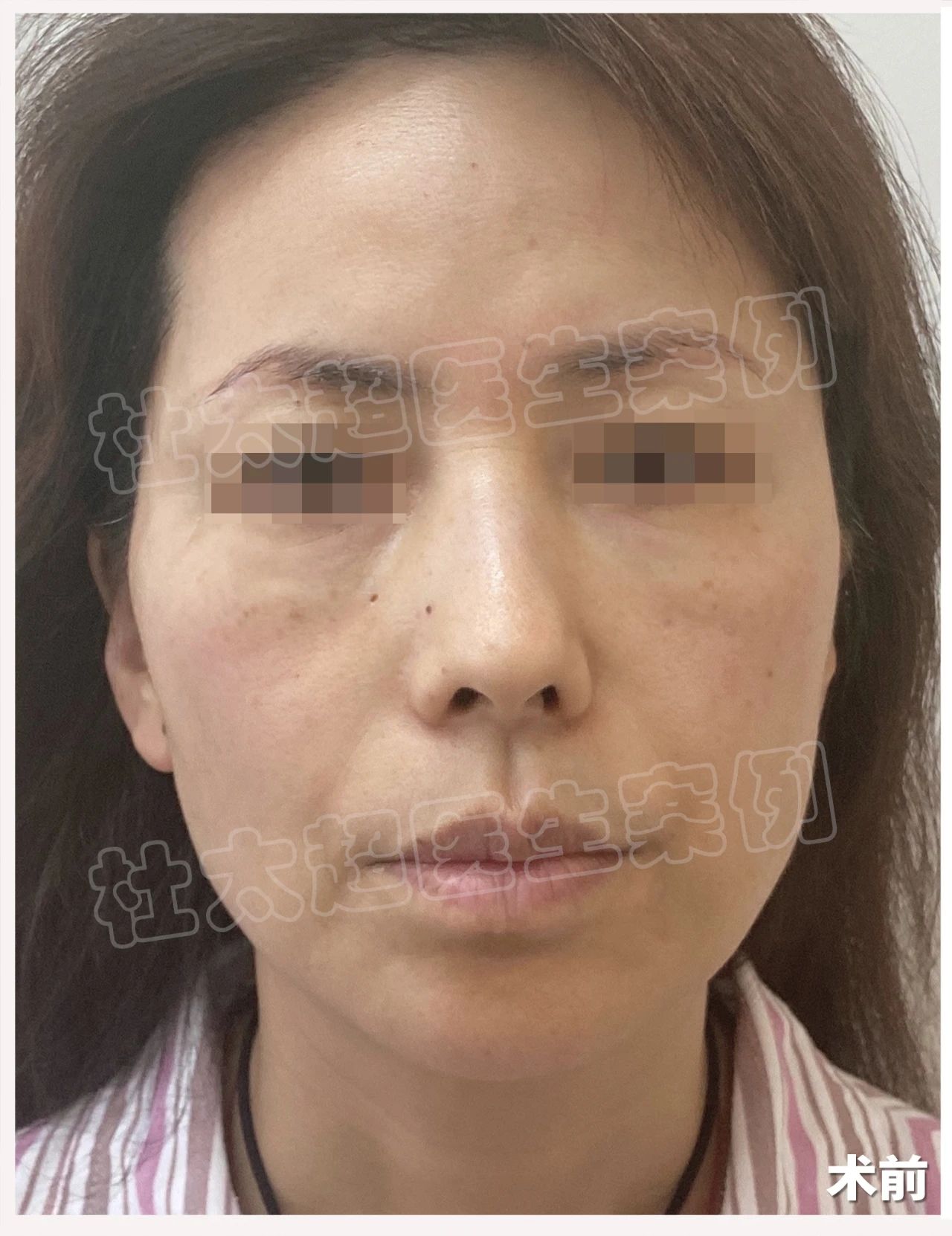 朋友圈重现颜值担当，3小时拉皮手术后100%自信回归！