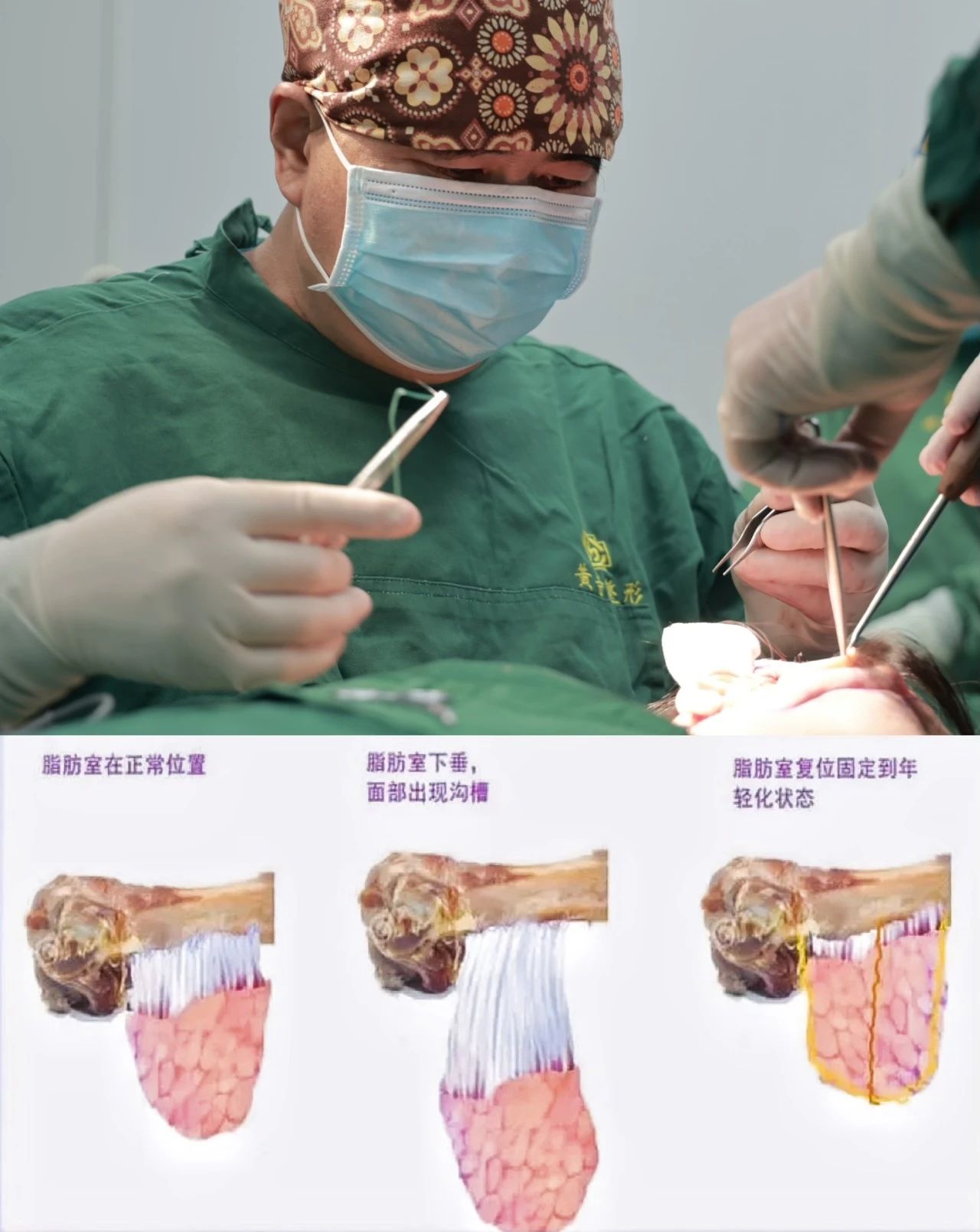 为何只有拉皮手术才能有效改善松弛型法令纹？