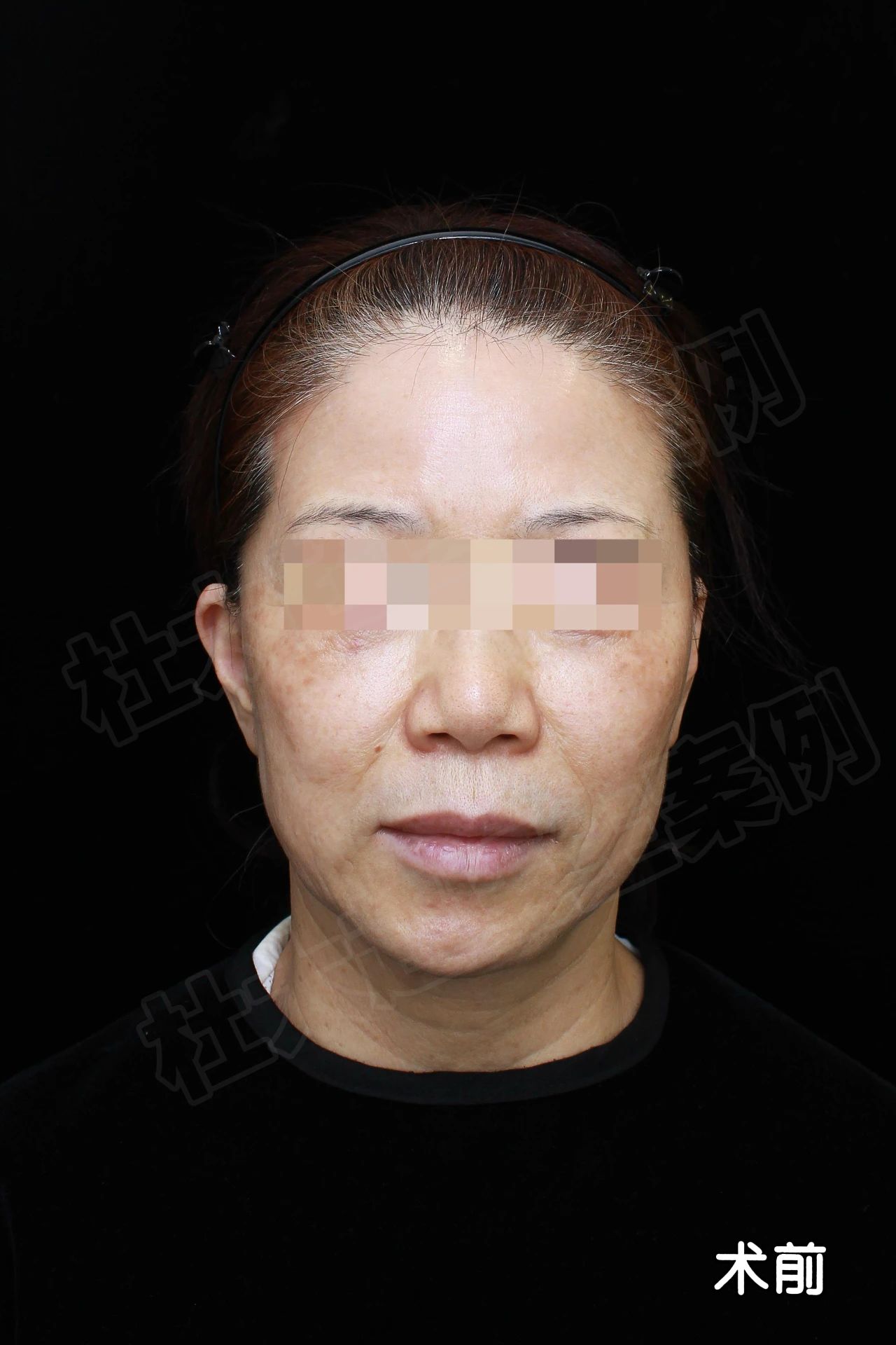 从“发”愁到“发”光：55岁我的拉皮手术小经历