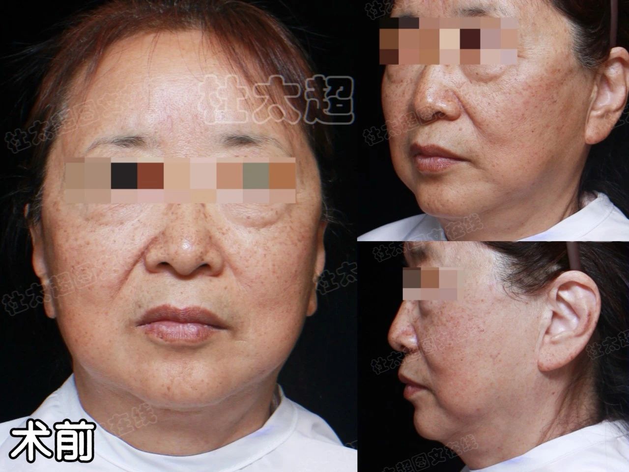 1次手术，10倍效果！66岁挑战0皱纹，拉皮手术的颠覆性改变