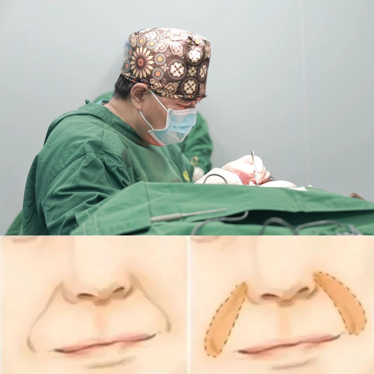 小孩脸上的法令纹为什么不显老？深度法令纹该如何去除？