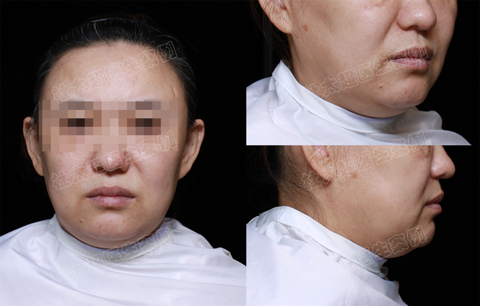 不满下颌缘松垂，遂做了拉皮手术，术后变化太惊人！