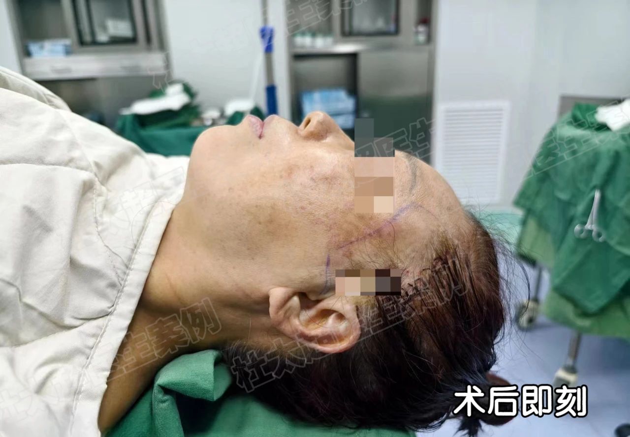 到底什么是年轻？60岁女士用1次拉皮手术逆转20年的时间秘密！