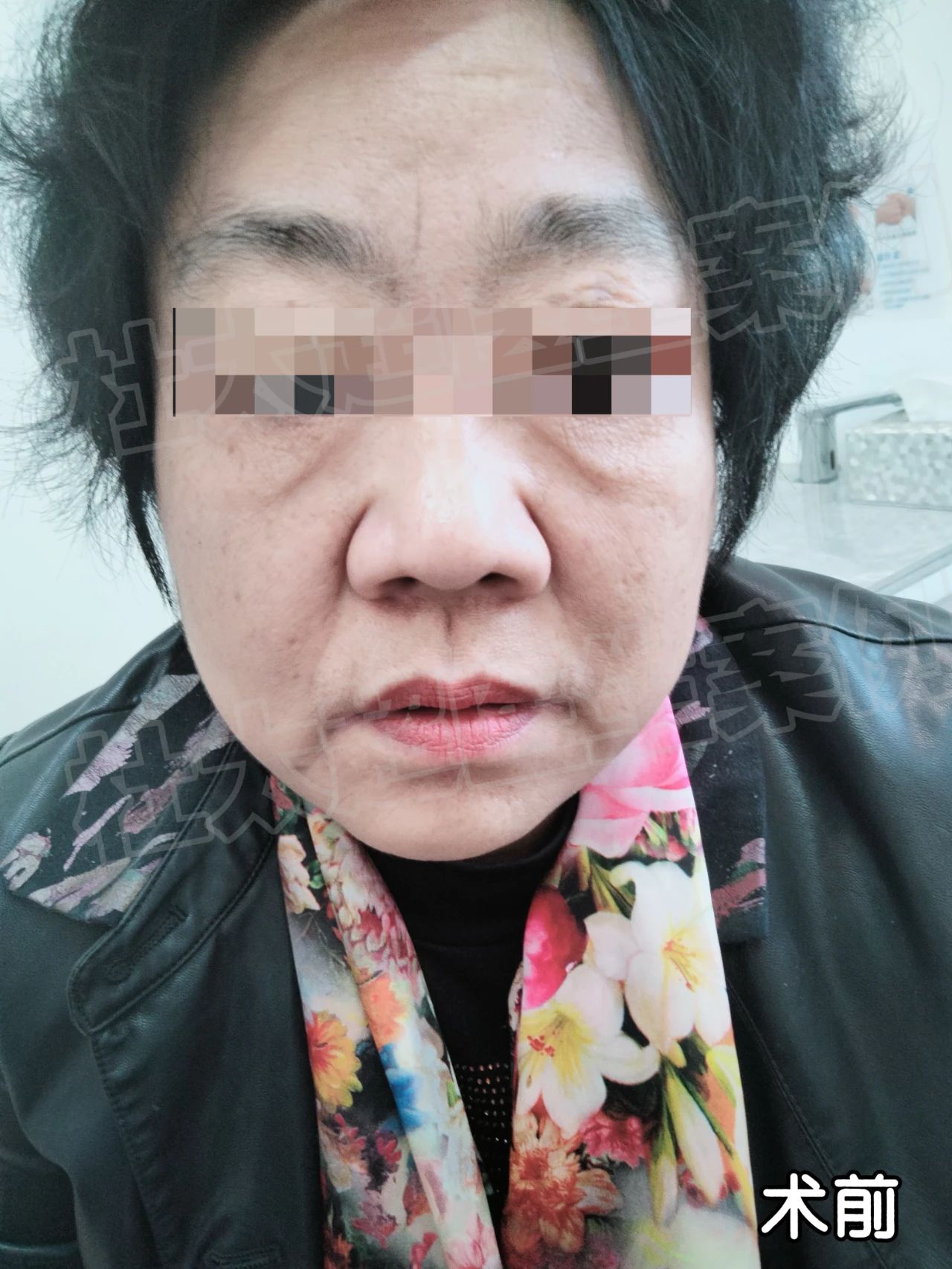 告别“一脸横肉”，59岁的我历经3小时拉皮手术，术后7个月实现美丽大蜕变！