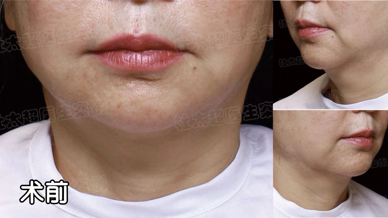 历经生长因子、线雕，这张脸何去何从？拉皮手术能否力挽狂澜？看结果！