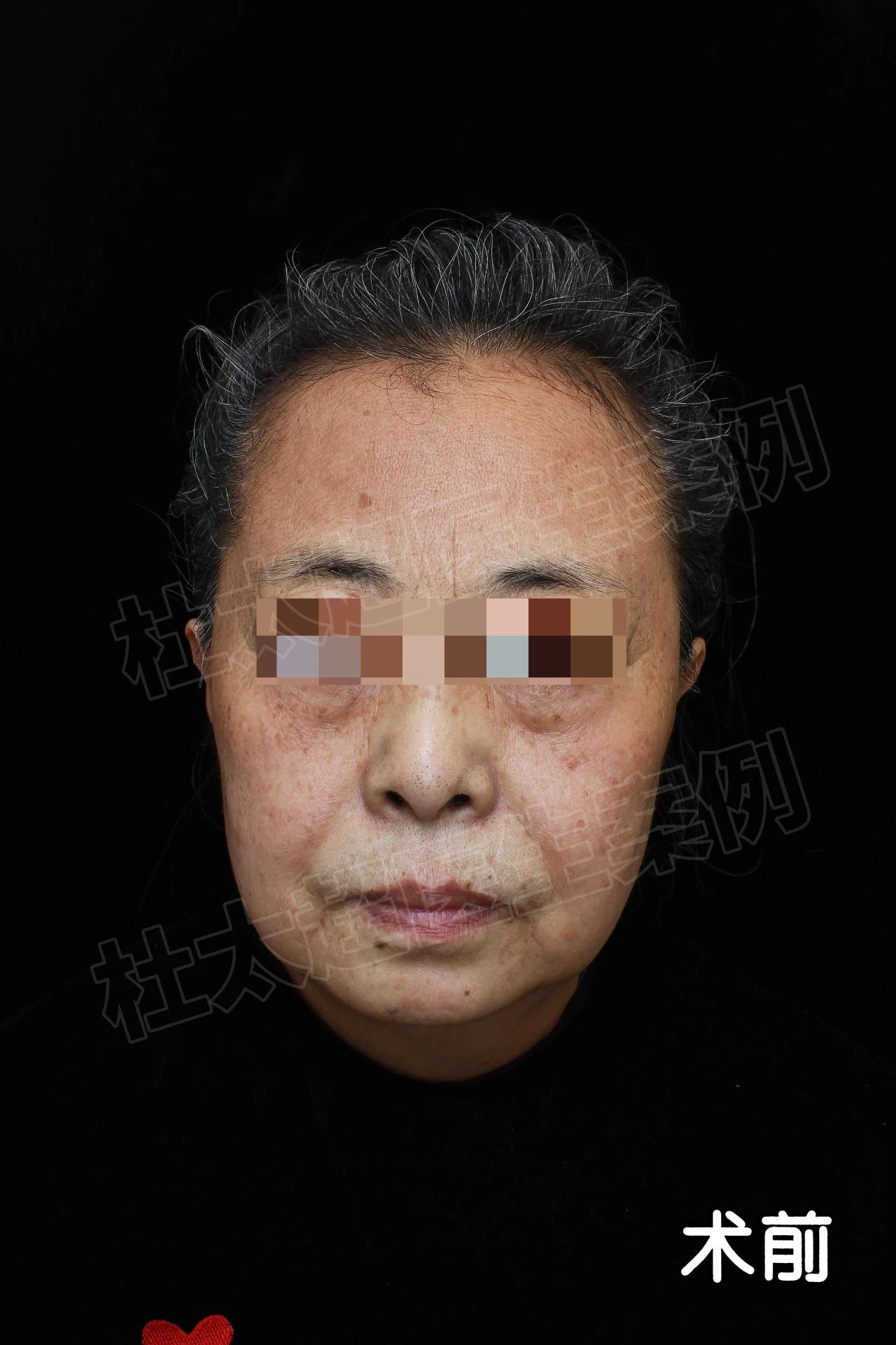 60岁奶奶实话实说:你家的拉皮手术,我就认定了!别的都不考虑! 60岁奶奶实话实说:你家的拉皮手术,我就认定了!别的都不考虑!