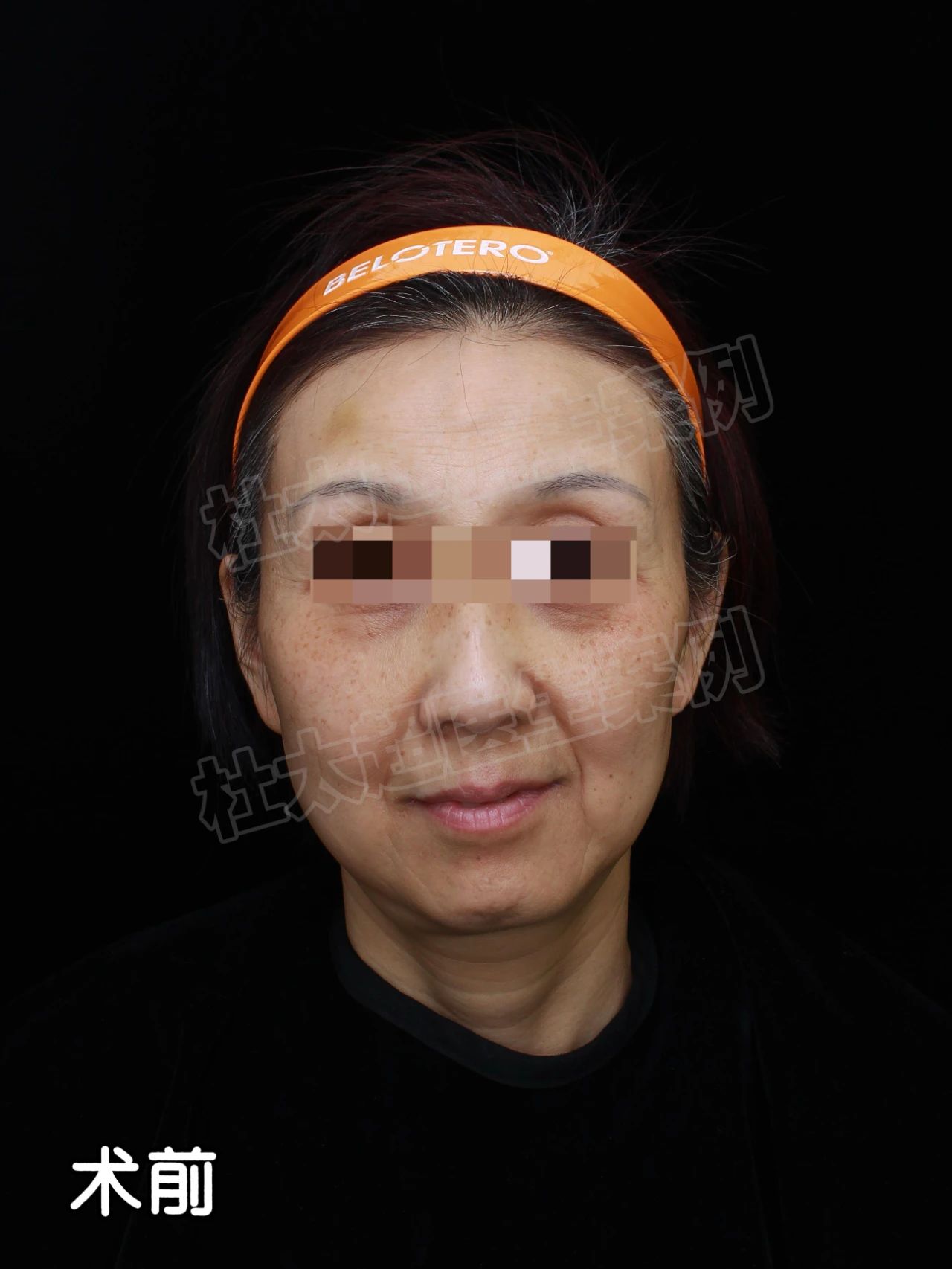 一意孤行，我飞中国做拉皮！3小时手术，7天恢复期，40天后却让我泪目！