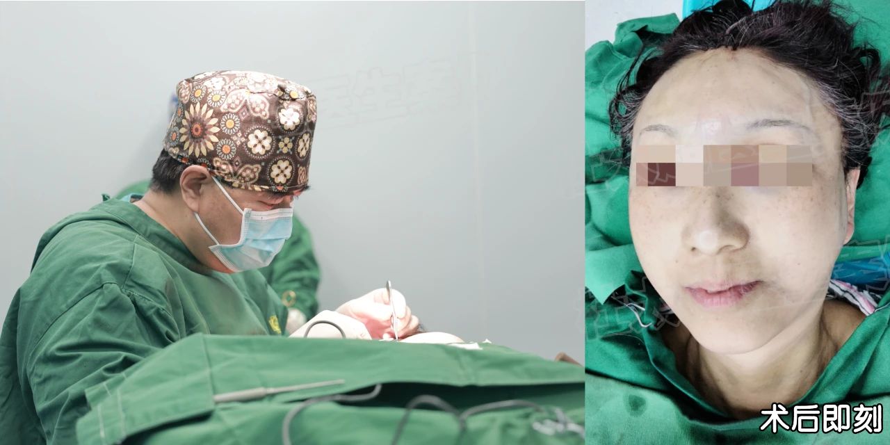 一意孤行，我飞中国做拉皮！3小时手术，7天恢复期，40天后却让我泪目！