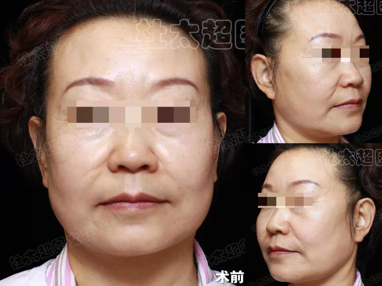 拉皮手术，56岁的我亲测了！3小时年轻10几岁，现在觉得超值，就是有点后悔做晚了！