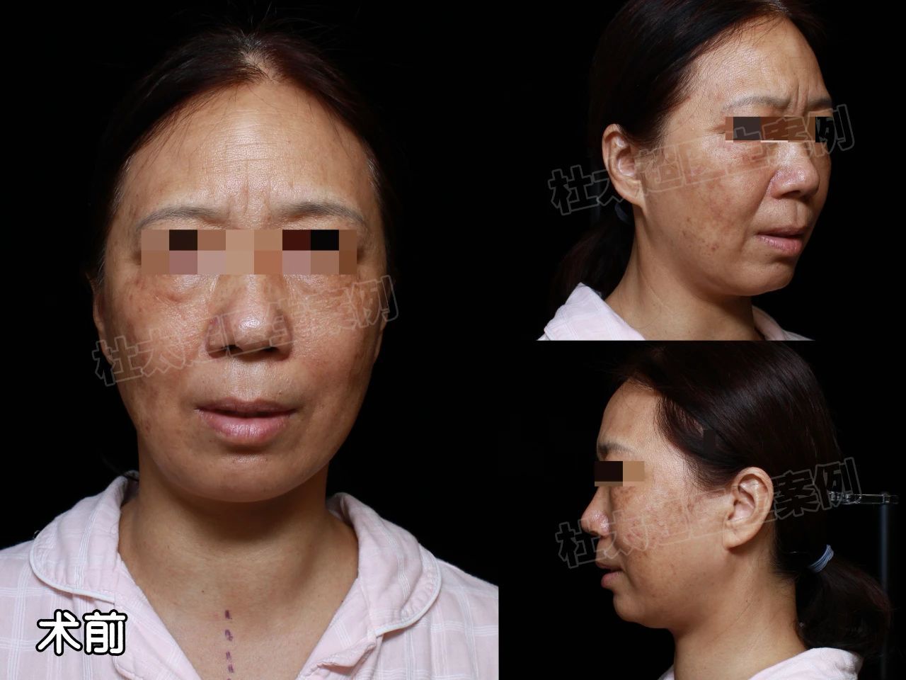 一次减龄20岁！这样的拉皮效果我是没想到的！