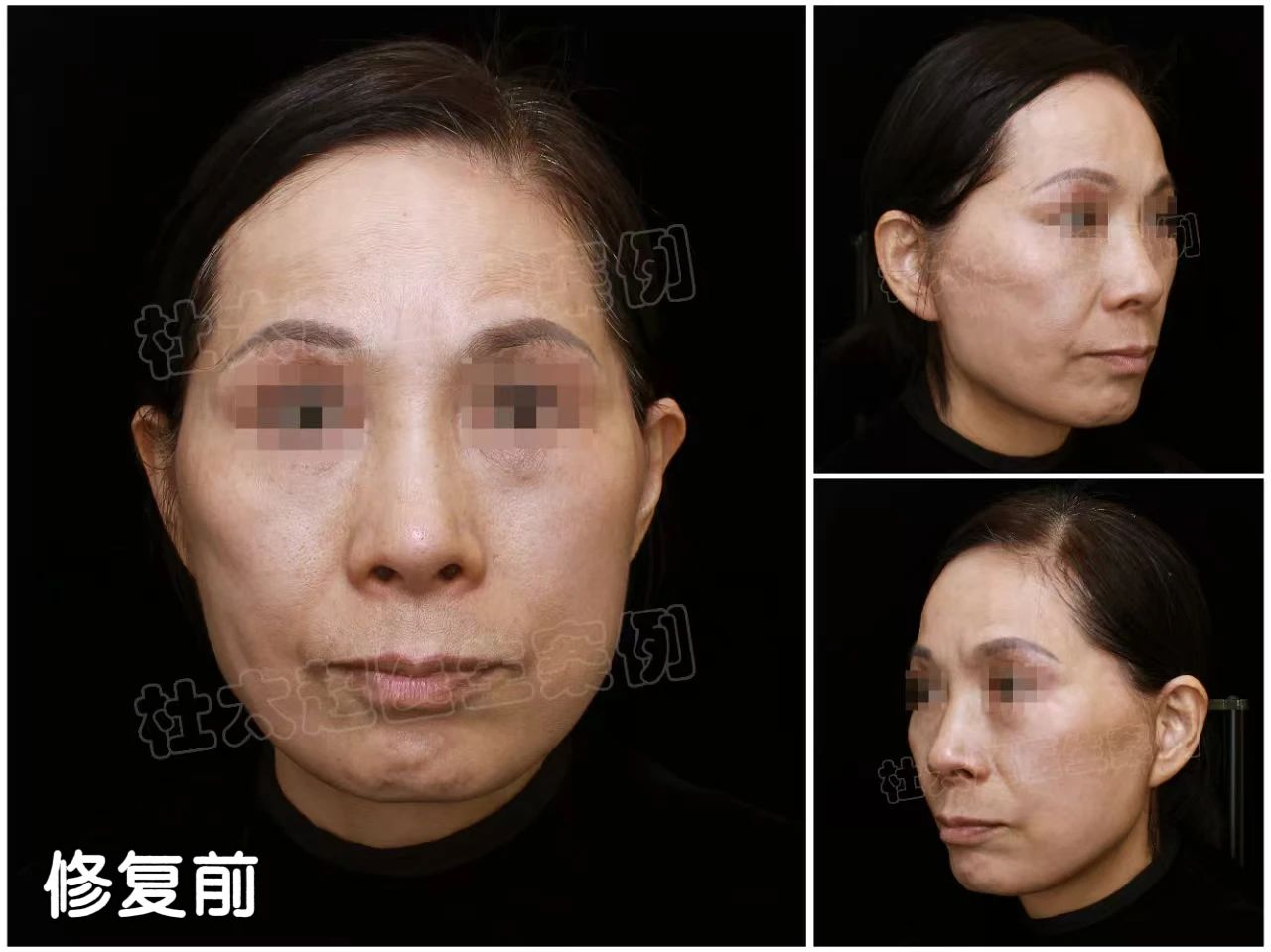 没想到!医生也会贪便宜吃大亏,2次拉皮手术的惨痛教训值得让人深刻反思! 没想到!医生也会贪便宜吃大亏,2次拉皮手术的惨痛教训值得让人深刻反思!