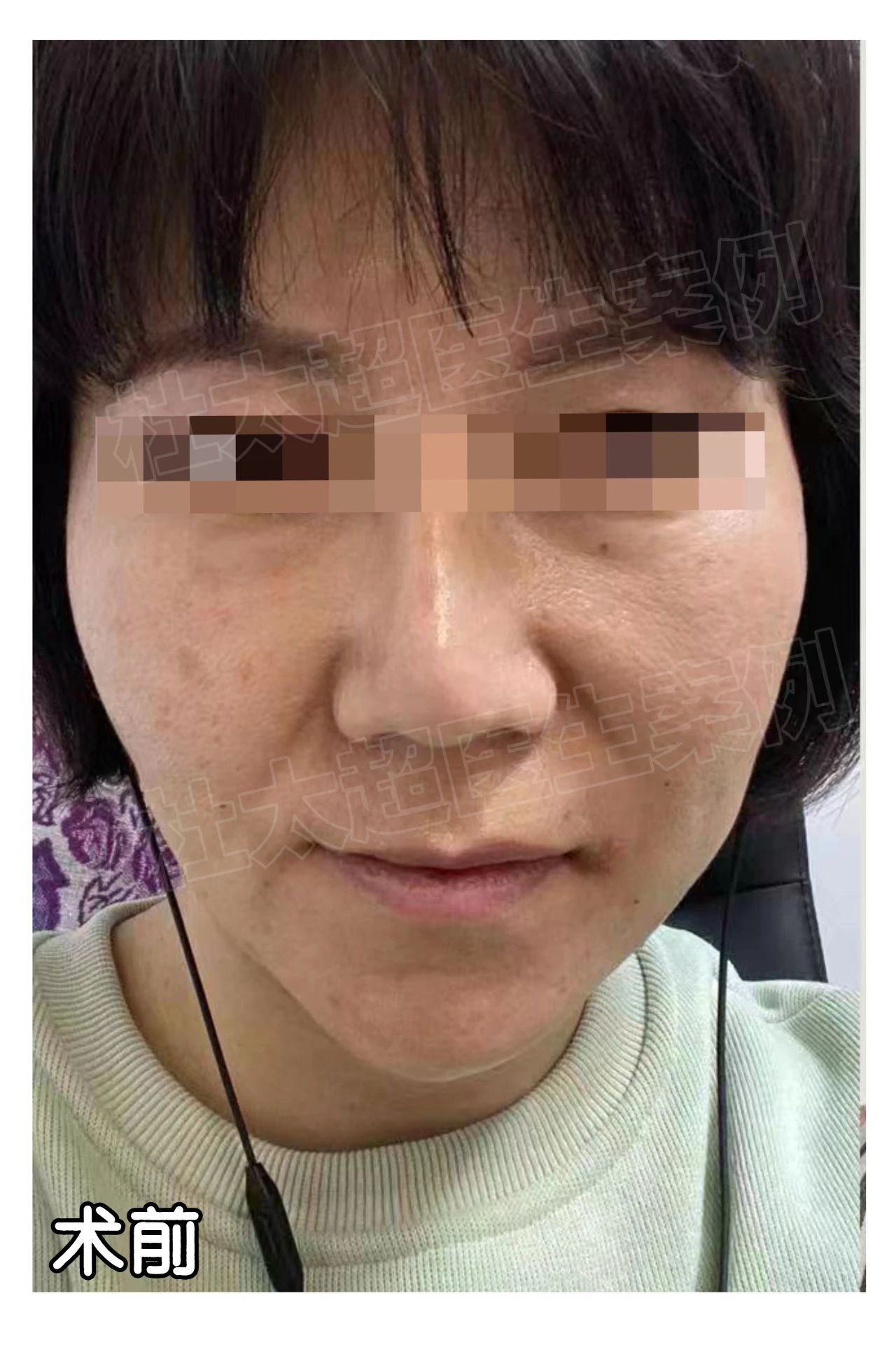 惊奇！拉皮手术还能告别“班味”？第二天却肿的像个馒头！！！